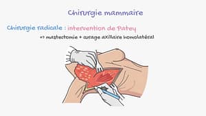 Traitement du cancer du sein